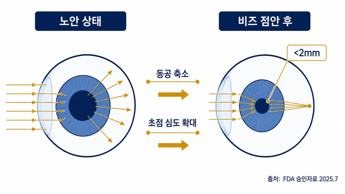 비즈 작용 원리 핀홀 효과 노안 안약 핀홀 효과 동공 축소 원리 다이어그램